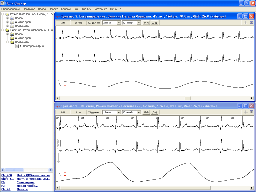 Изображение электрокардиографа Поли-Спектр-Радио-1 - диаграмма исследований.